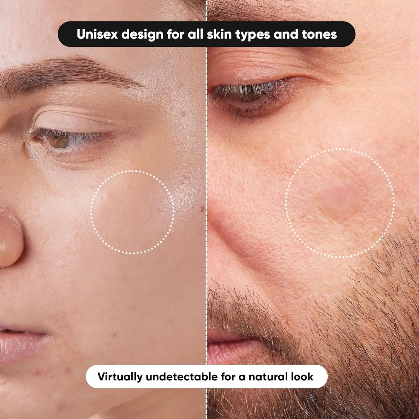 ✨ Hydrocolloid Acne Patches (Value Box) ✨